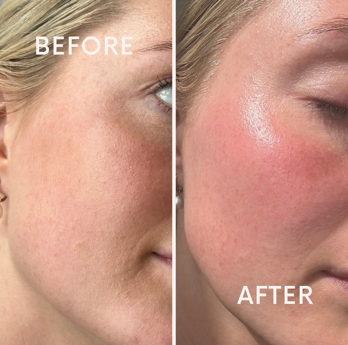 Dermaplaning Edinburgh